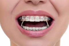 elastics-in-orthodontic-treatment