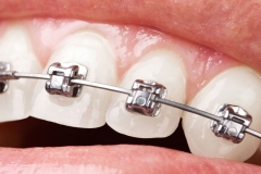 traditional-orthodontics-plano
