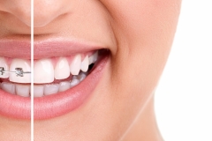 invisalign