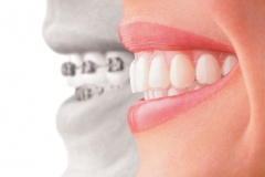 smile_with_invisalign